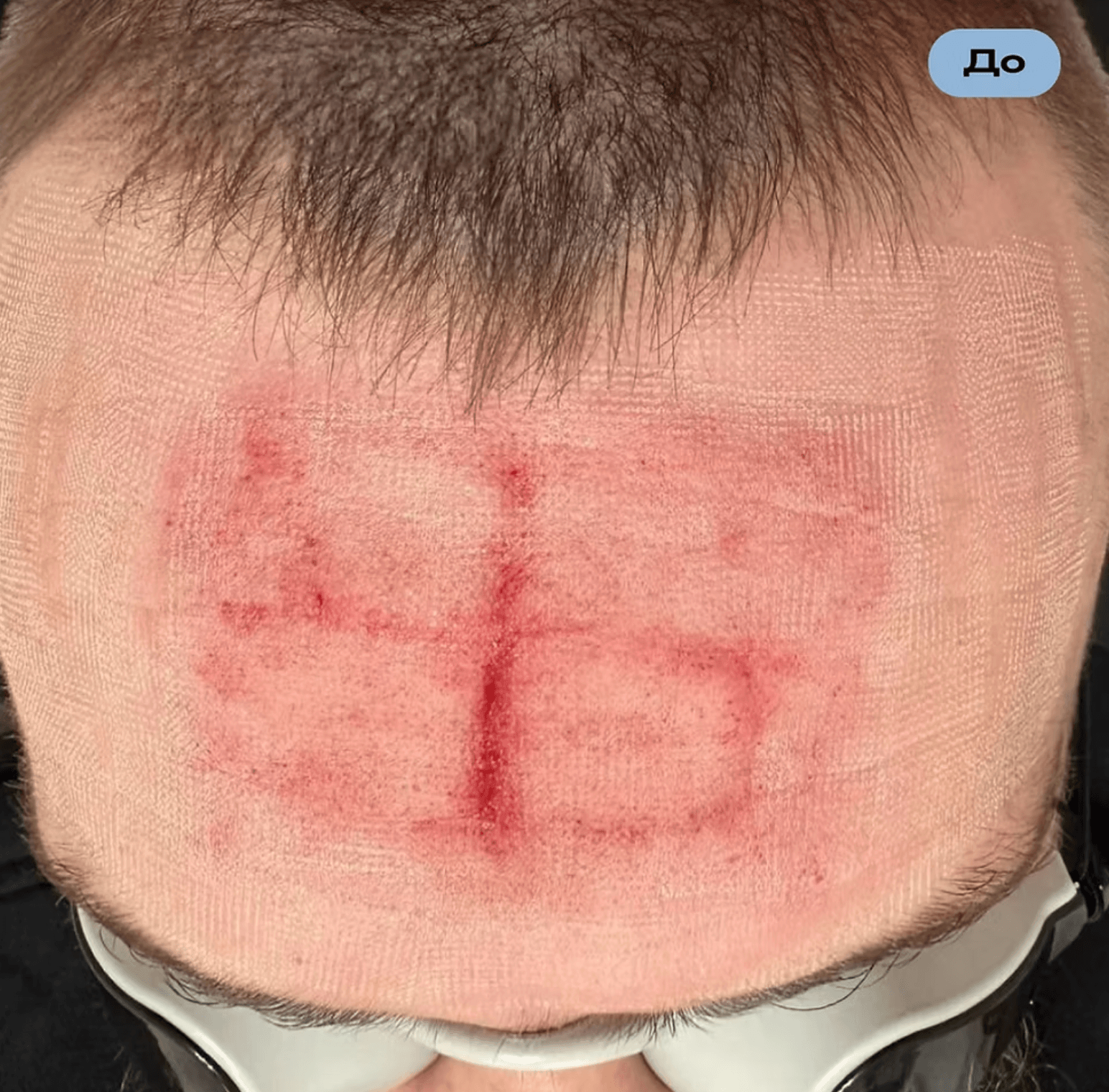 Several Ukrainian defenders returned from the russian captivity with swastika-shaped scars, some on their foreheads.Several Ukrainian defenders returned from the russian captivity with swastika-shaped scars, some on their foreheads.
