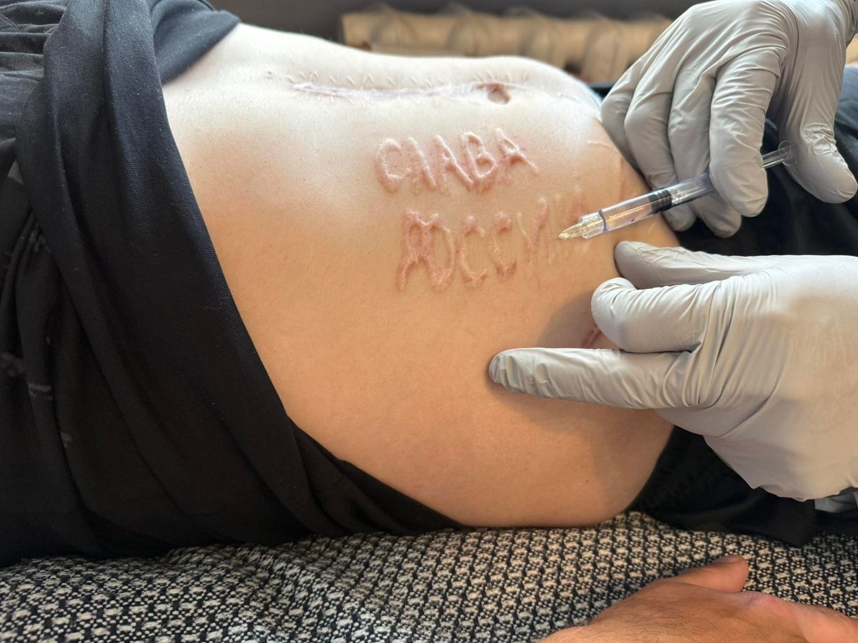 The words "Glory to Russia" were branded onto the right side of a wounded Ukrainian prisoner of war (POW) by a Russian doctor during an operation.