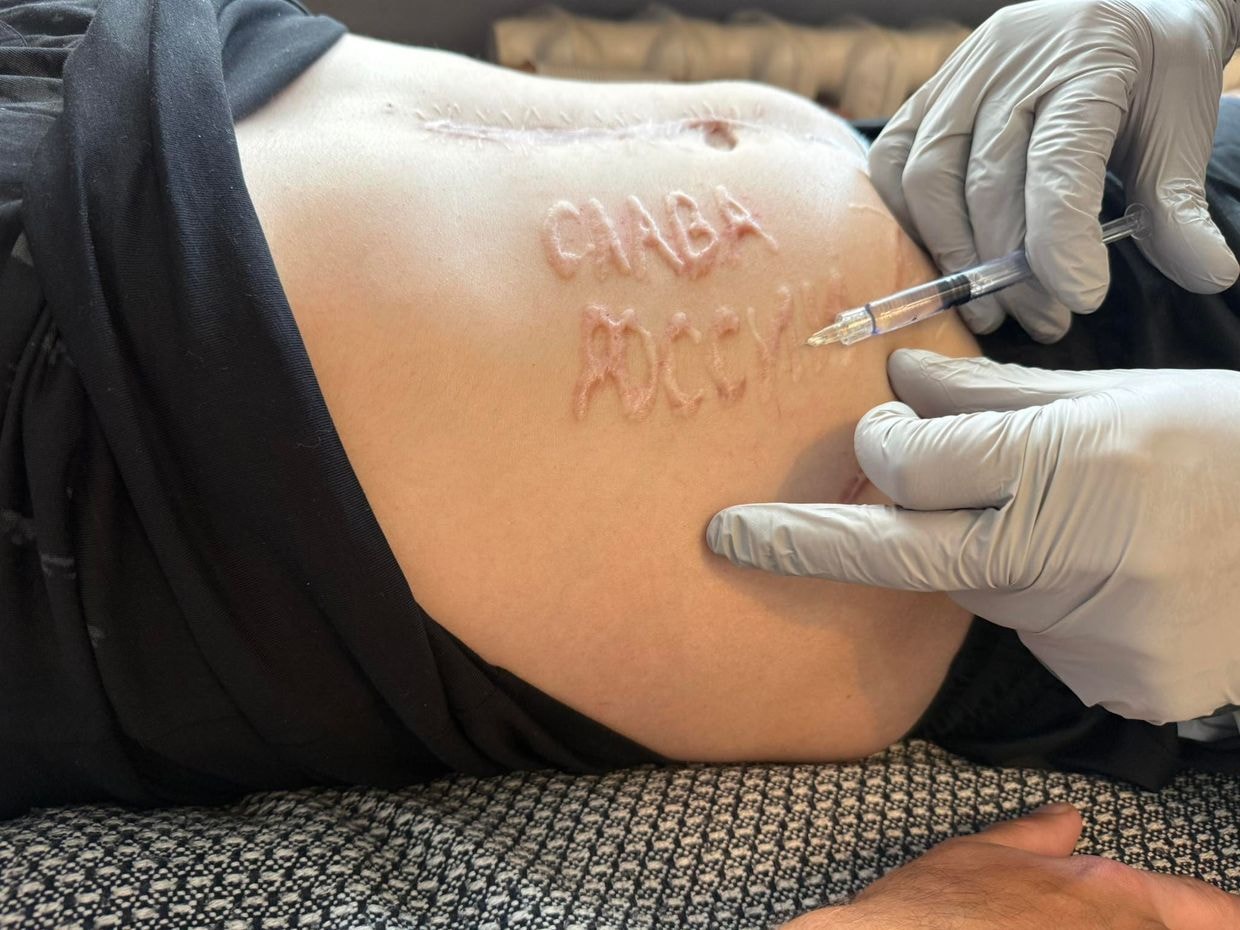 The words "Glory to Russia" branded onto the wounded Ukrainian POW by a russian doctor during an operation.